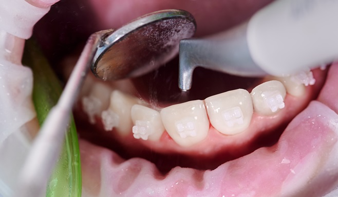 Toothache Remedies That Work (and Don’t): An Emergency Dentist's Advice