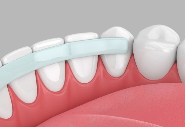 What is Dental Bonding?