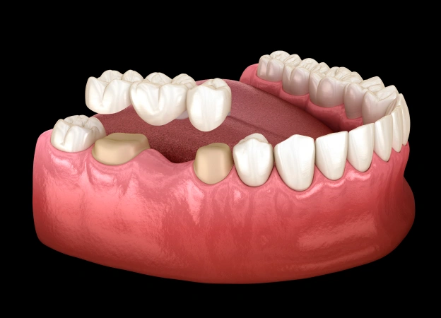 What is a Dental Bridge?