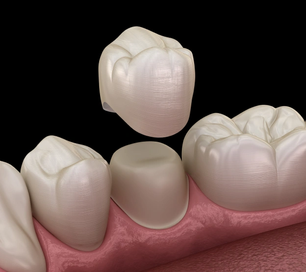 What Are Dental Crowns?