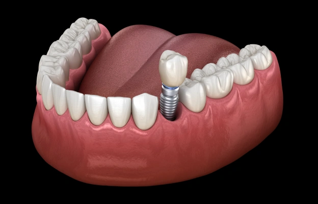 What Are My Options After Losing Teeth?