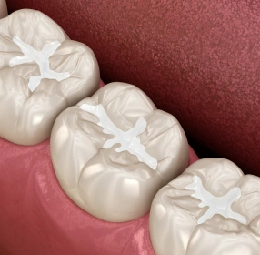 Dental Sealants